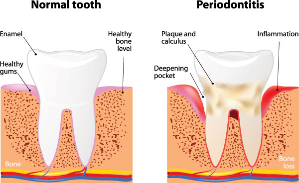 periodontal